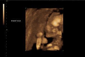 Ultra sound scan of fetus